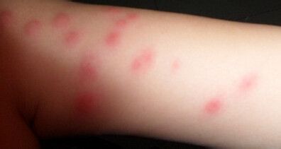 被旧床垫里面的虫子咬了